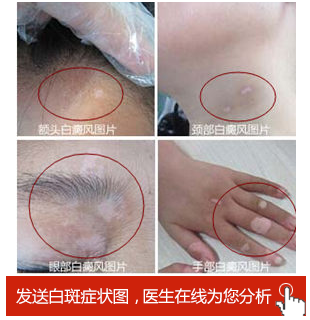 白癜风初期症状是什么样的